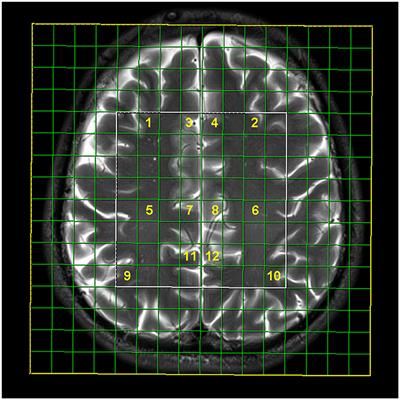 CNS efficacy parameters of combination antiretroviral therapy in chronic HIV infection: A multi-voxel magnetic resonance spectroscopy study